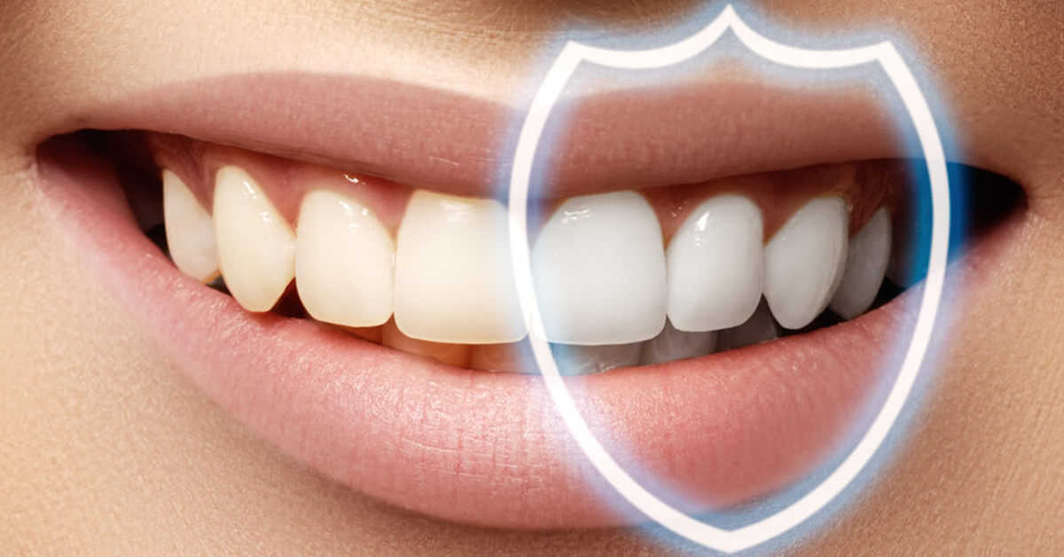 Everything you need to know about Dental Bonding