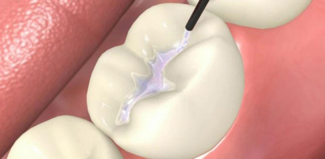 Why are dental sealants needed for our Teeth?