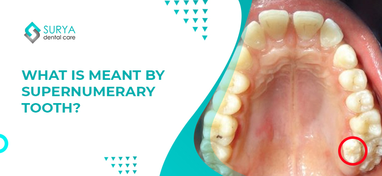 What is meant by Supernumerary tooth?