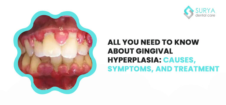 All You need to know about Gingival Hyperplasia