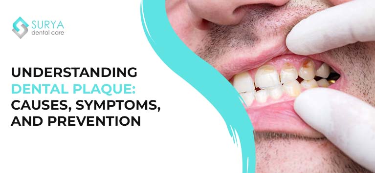 Understanding Dental Plaque: Causes, Symptoms, and Prevention
