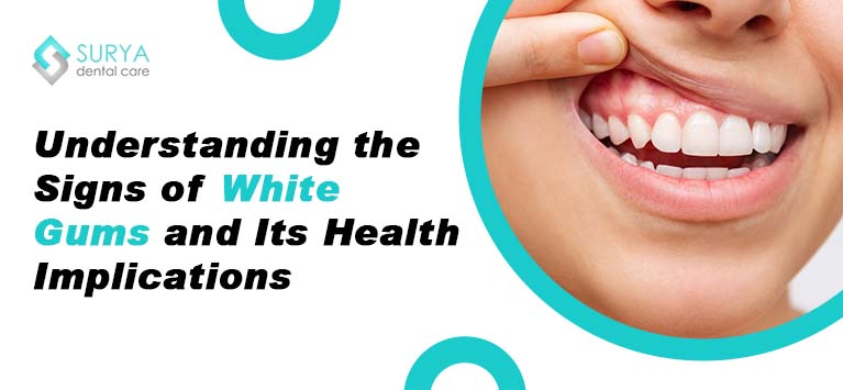 Understanding the Signs of White Gums and Its Health Implications