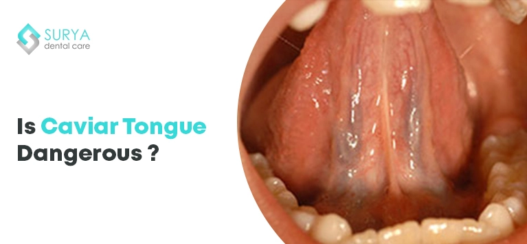 Is Caviar Tongue Dangerous ?