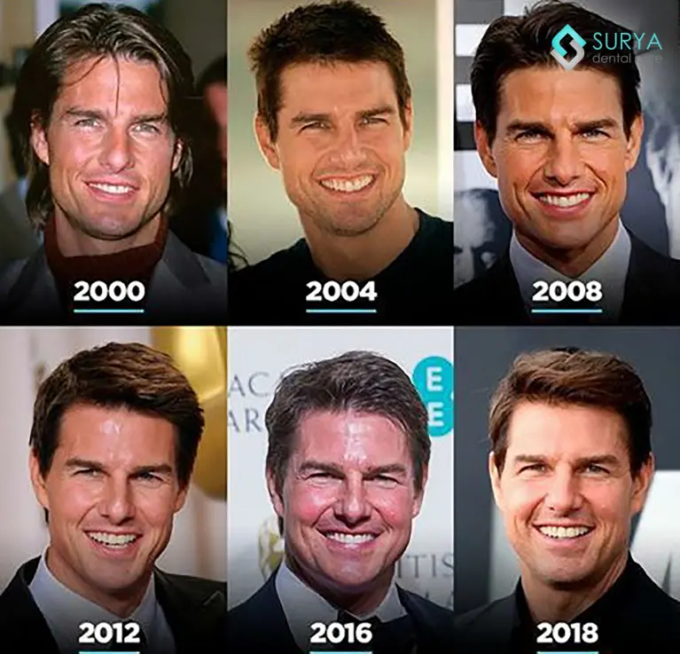 Tom Cruise teeth - Before & After