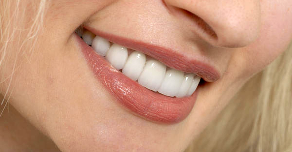 Benefits of getting lumineers for teeth