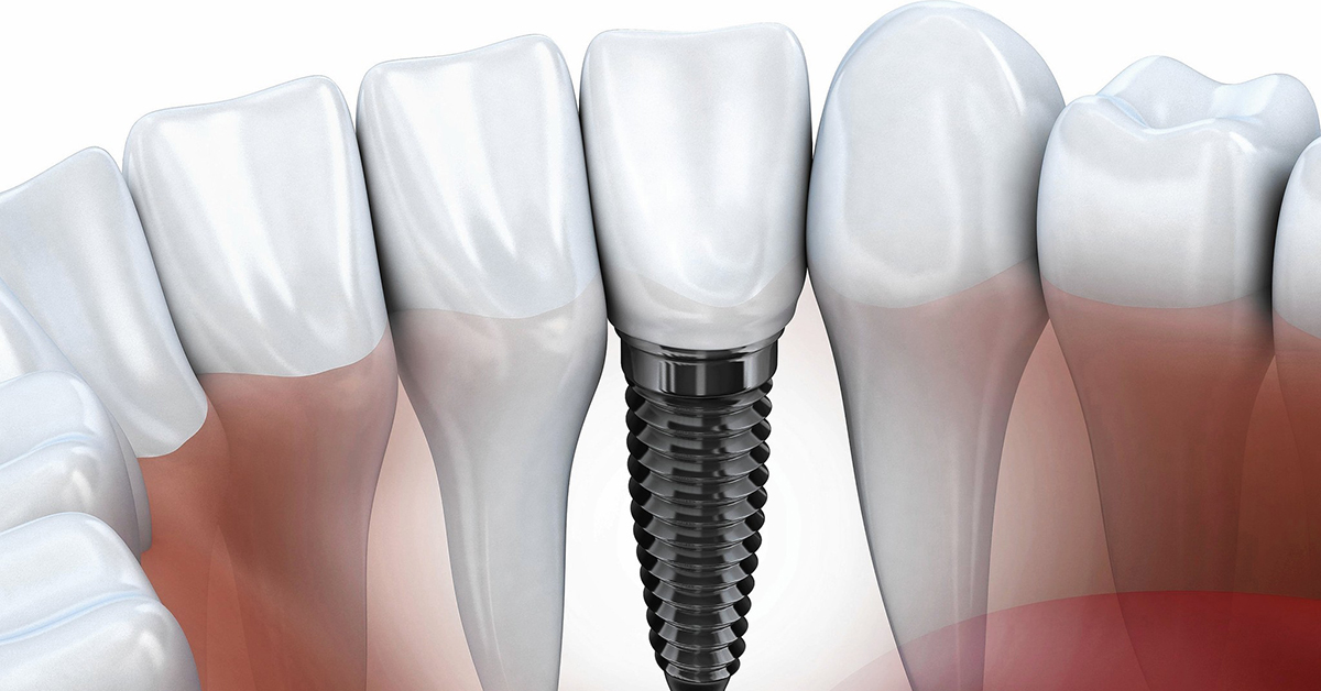 Risk factors and problems associated with dental implants
