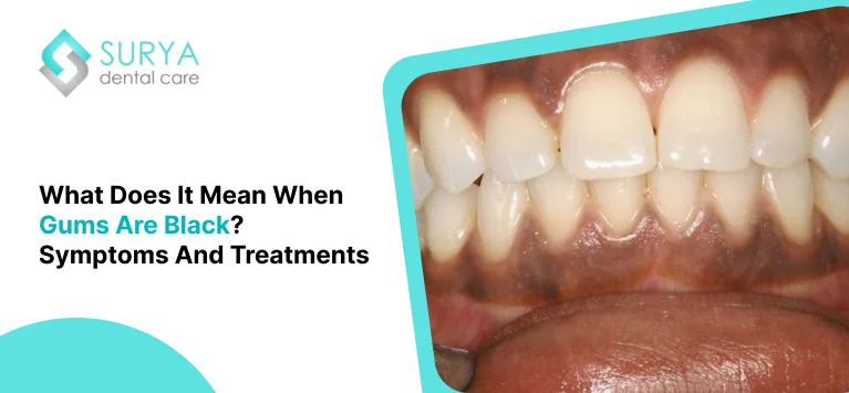 Black gums - what does it mean when you have black gums?