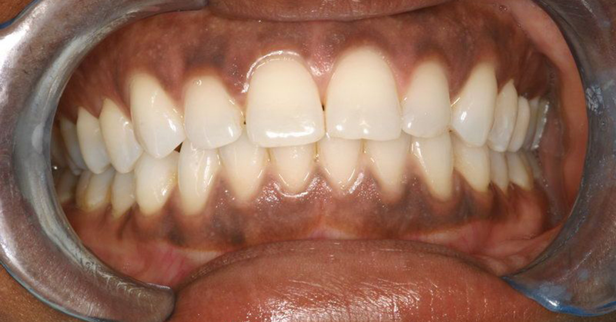 What is Black gum Disease?