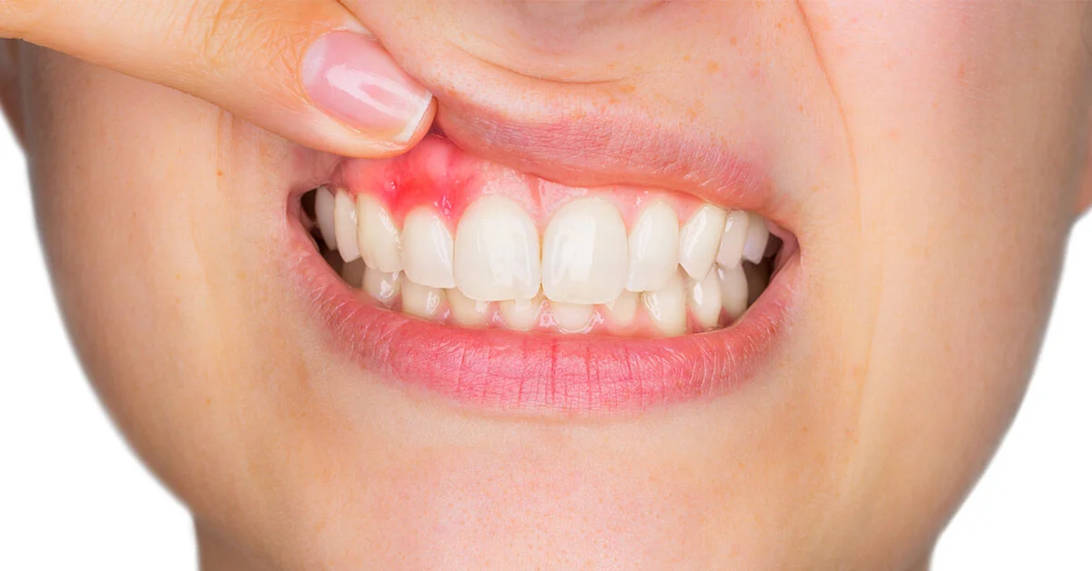 Untreated Gum Disease