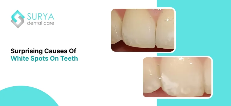 White Spots on teeth