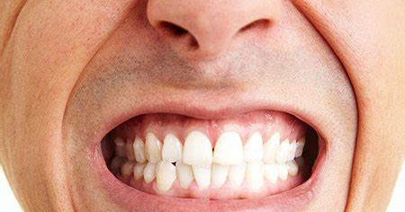 What causes teeth Grinding?