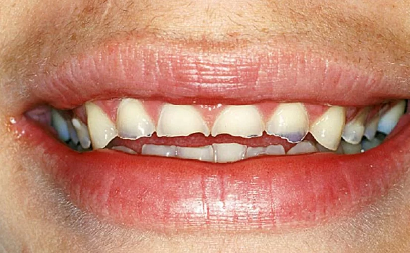 how to stop enamel erosion