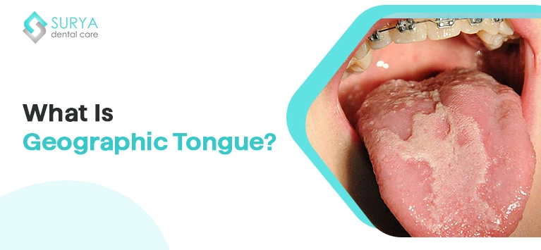 what is Geographic Tongue