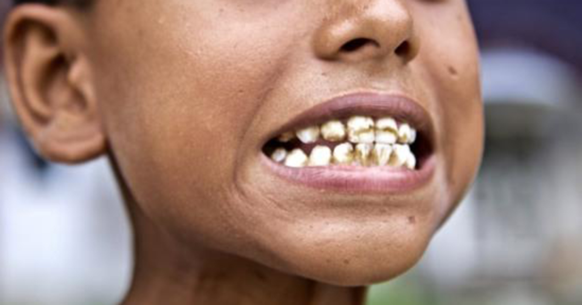 Dental Fluorosis – Symptoms, Causes and Treatment