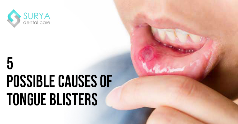 5 Possible causes of tongue blisters