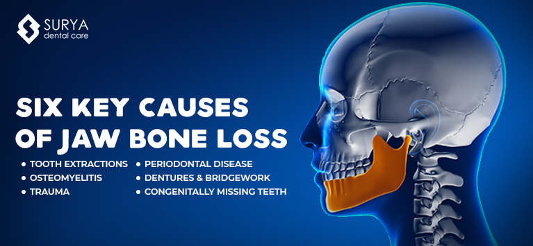 6 Key causes of jaw bone loss