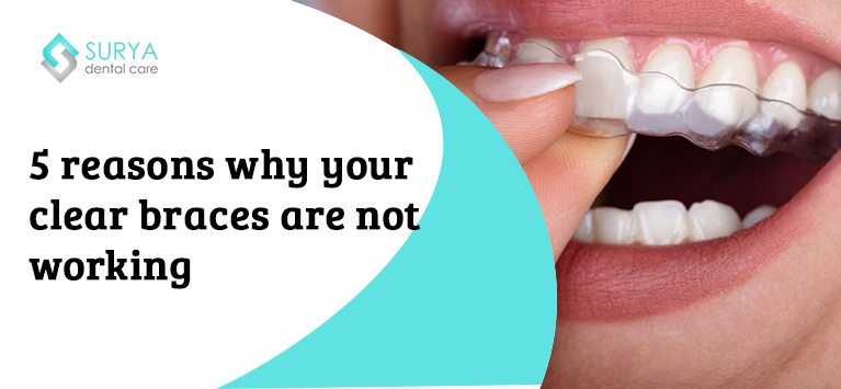5 reasons why your clear braces are not working