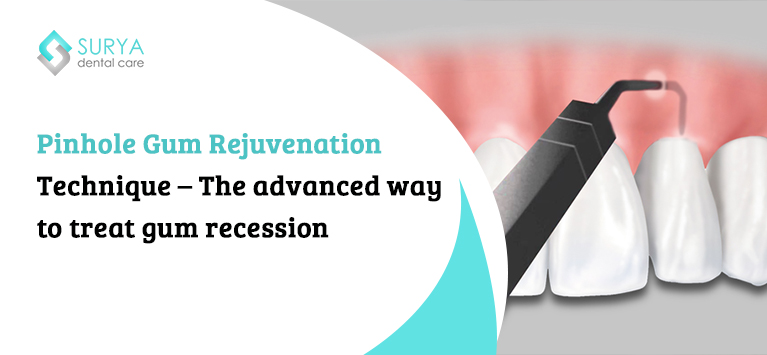 Pinhole Gum Rejuvenation Technique – The advanced way to treat gum recession