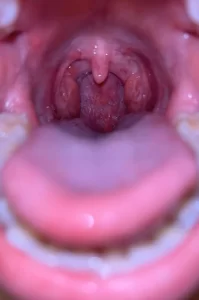 HPV In Mouth Pictures