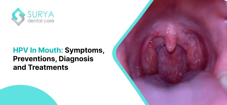 HPV In Mouth