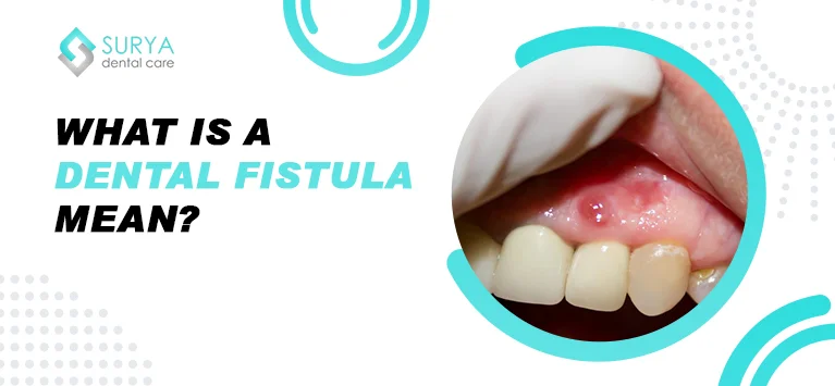 Dental Fistula