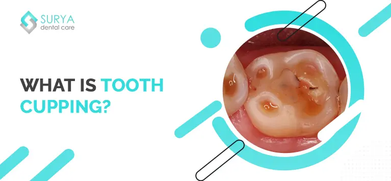 Tooth Cupping | Teeth Cupping Before and After