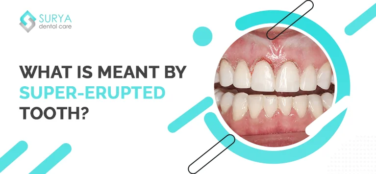 What is meant by Super Erupted teeth?