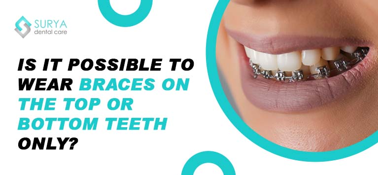 Is it possible to wear braces on the top or bottom teeth only?