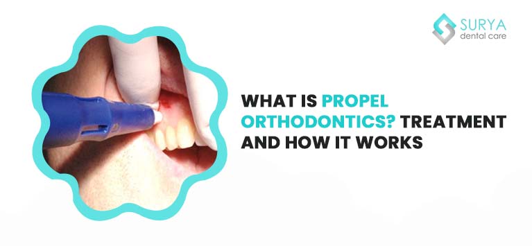 What is Propel Orthodontics? Treatment and how it works