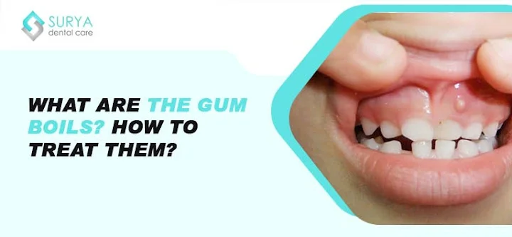 Gum Boils | Gum Abscess