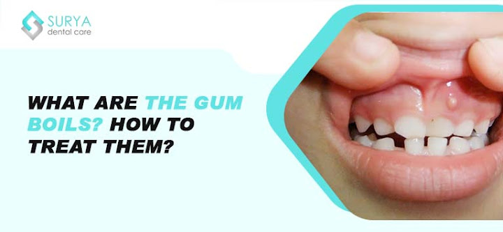 What are the gum boils? How to treat them?