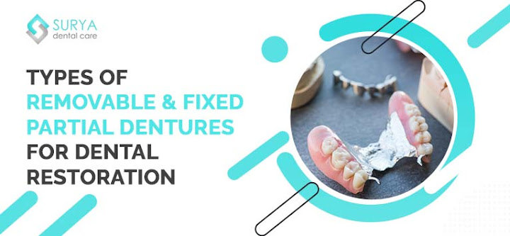 Types of removable & fixed partial dentures for dental restoration