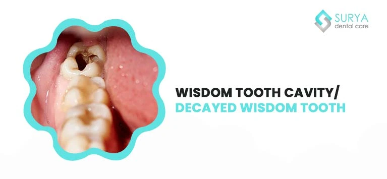 Wisdom Teeth Cavity | Wisdom Teeth and Cavities