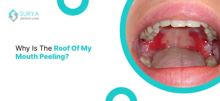 Roof of mouth Peeling | skin in mouth peeling