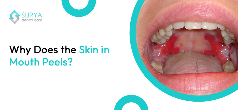 Why is the skin inside of your mouth peeling?