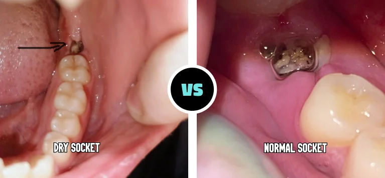 Dry Socket Vs Normal Socket After Tooth Extraction