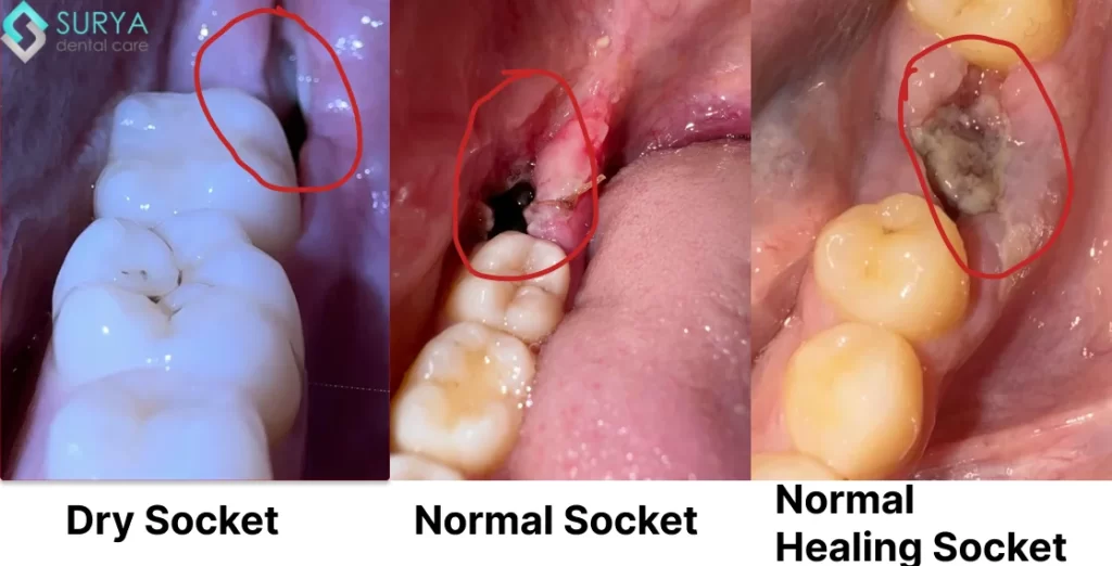 pictures of dry socket vs normal healing | Normal Socket After Tooth Extraction