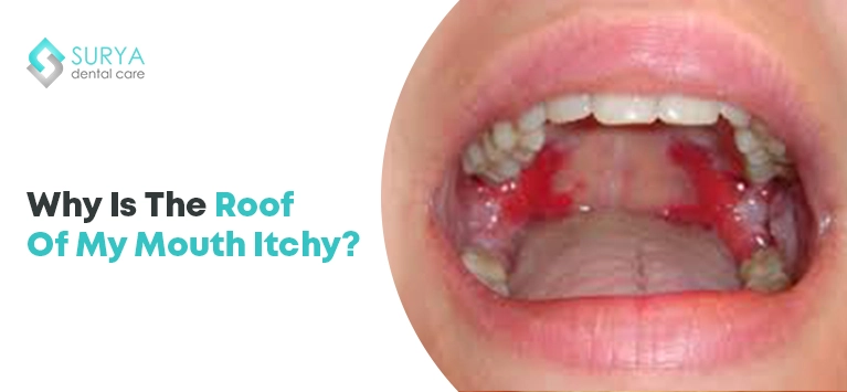 Why is the roof of my mouth itchy?