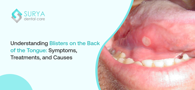Blisters on the Back of the Tongue