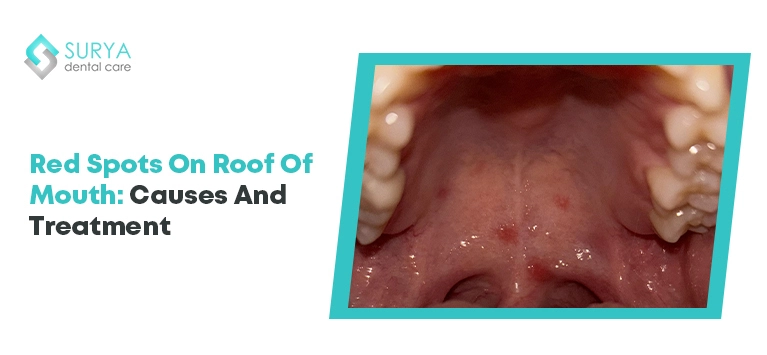 Red Spots on Roof of Mouth: Causes and Treatment