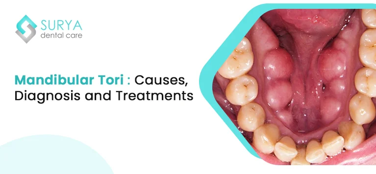 Mandibular Tori | Dental Tori | torus mandibularis