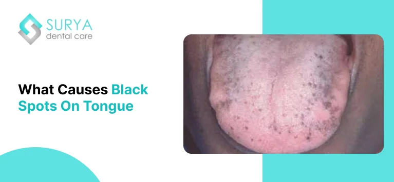 Black Spots on tongue Image