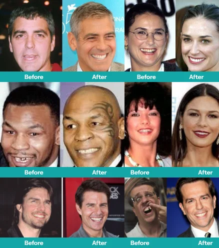 Celebrities with Dental Implants - Tom Cruise | 50 Cent | Ed Helms | George Clooney | Christie Brinkley | Mike Tyson | Demi Moore