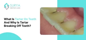 What is Tartar On Teeth | Why is tartar breaking off teeth