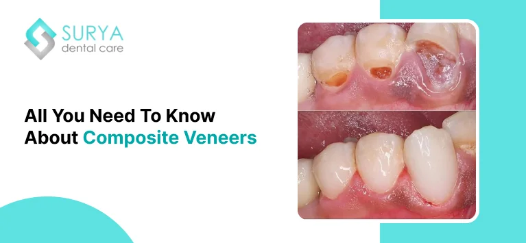 Composite veneers