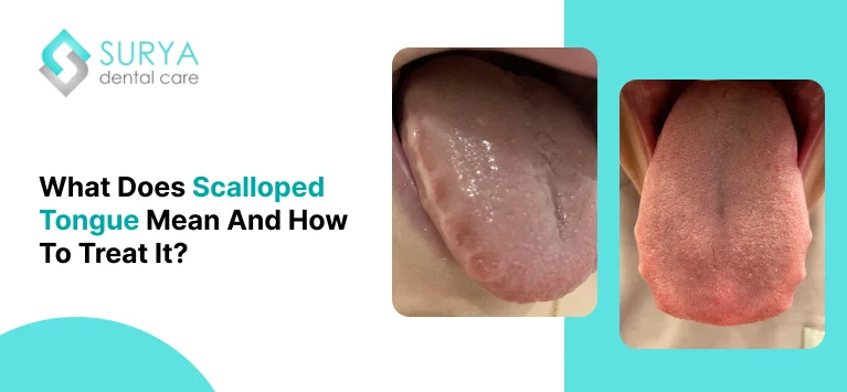 What Does Scalloped Tongue Mean And How To Treat It?