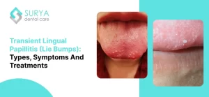 Transient Lingual Papillitis | Lie Bumps