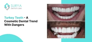 Turkey Teeth - A Cosmetic Dental Trend