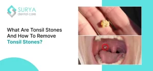 What are Tonsil Stones and How To Remove Tonsil Stones?