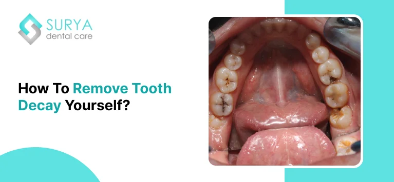 How To Remove Tooth Decay Yourself